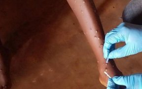 Mpox : l’OMS approuve le premier test de diagnostic pour une utilisation en situation d’urgence