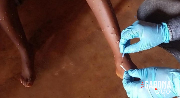 Mpox : l’OMS approuve le premier test de diagnostic pour une utilisation en situation d’urgence